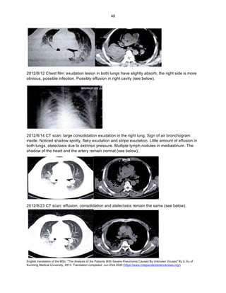 English translation of the MSc: "The Analysis of Six Patients With Severe Pneumonia Caused By Unknown Viruses" By Li Xu of
Kunming Medical University, 2013. Translation completed: Jun 23rd 2020 (https://www.independentsciencenews.org/)
	
	
40	
2012/8/12 Chest film: exudation lesion in both lungs have slightly absorb, the right side is more
obvious, possible infection. Possibly effusion in right cavity (see below).
2012/8/14 CT scan: large consolidation exudation in the right lung, Sign of air bronchogram
inside. Noticed shadow spotty, flaky exudation and stripe exudation. Little amount of effusion in
both lungs, atelectasis due to extrinsic pressure. Multiple lymph nodules in mediastinum. The
shadow of the heart and the artery remain normal (see below).
2012/8/23 CT scan: effusion, consolidation and atelectasis remain the same (see below).
 