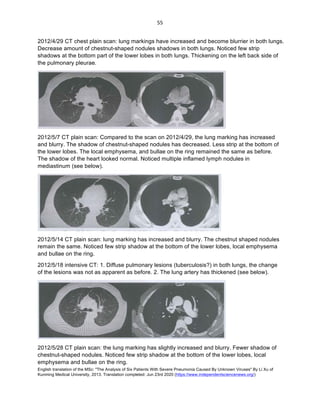 English translation of the MSc: "The Analysis of Six Patients With Severe Pneumonia Caused By Unknown Viruses" By Li Xu of
Kunming Medical University, 2013. Translation completed: Jun 23rd 2020 (https://www.independentsciencenews.org/)
	
	
55	
2012/4/29 CT chest plain scan: lung markings have increased and become blurrier in both lungs.
Decrease amount of chestnut-shaped nodules shadows in both lungs. Noticed few strip
shadows at the bottom part of the lower lobes in both lungs. Thickening on the left back side of
the pulmonary pleurae.
2012/5/7 CT plain scan: Compared to the scan on 2012/4/29, the lung marking has increased
and blurry. The shadow of chestnut-shaped nodules has decreased. Less strip at the bottom of
the lower lobes. The local emphysema, and bullae on the ring remained the same as before.
The shadow of the heart looked normal. Noticed multiple inflamed lymph nodules in
mediastinum (see below).
2012/5/14 CT plain scan: lung marking has increased and blurry. The chestnut shaped nodules
remain the same. Noticed few strip shadow at the bottom of the lower lobes, local emphysema
and bullae on the ring.
2012/5/18 intensive CT: 1. Diffuse pulmonary lesions (tuberculosis?) in both lungs, the change
of the lesions was not as apparent as before. 2. The lung artery has thickened (see below).
2012/5/28 CT plain scan: the lung marking has slightly increased and blurry. Fewer shadow of
chestnut-shaped nodules. Noticed few strip shadow at the bottom of the lower lobes, local
emphysema and bullae on the ring.
 