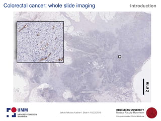 Jakob Nikolas Kather I Slide 4 I 8/22/2015
Colorectal cancer: whole slide imaging
2mm
Introduction
 