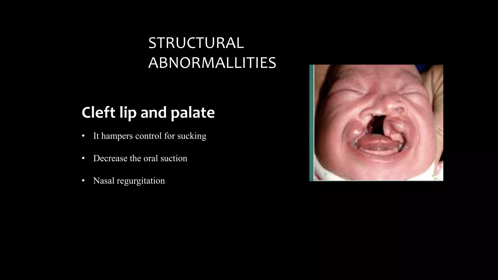 STRUCTURAL
ABNORMALLITIES
Cleft lip and palate
• It hampers control for sucking
• Decrease the oral suction
• Nasal regurgitation
 