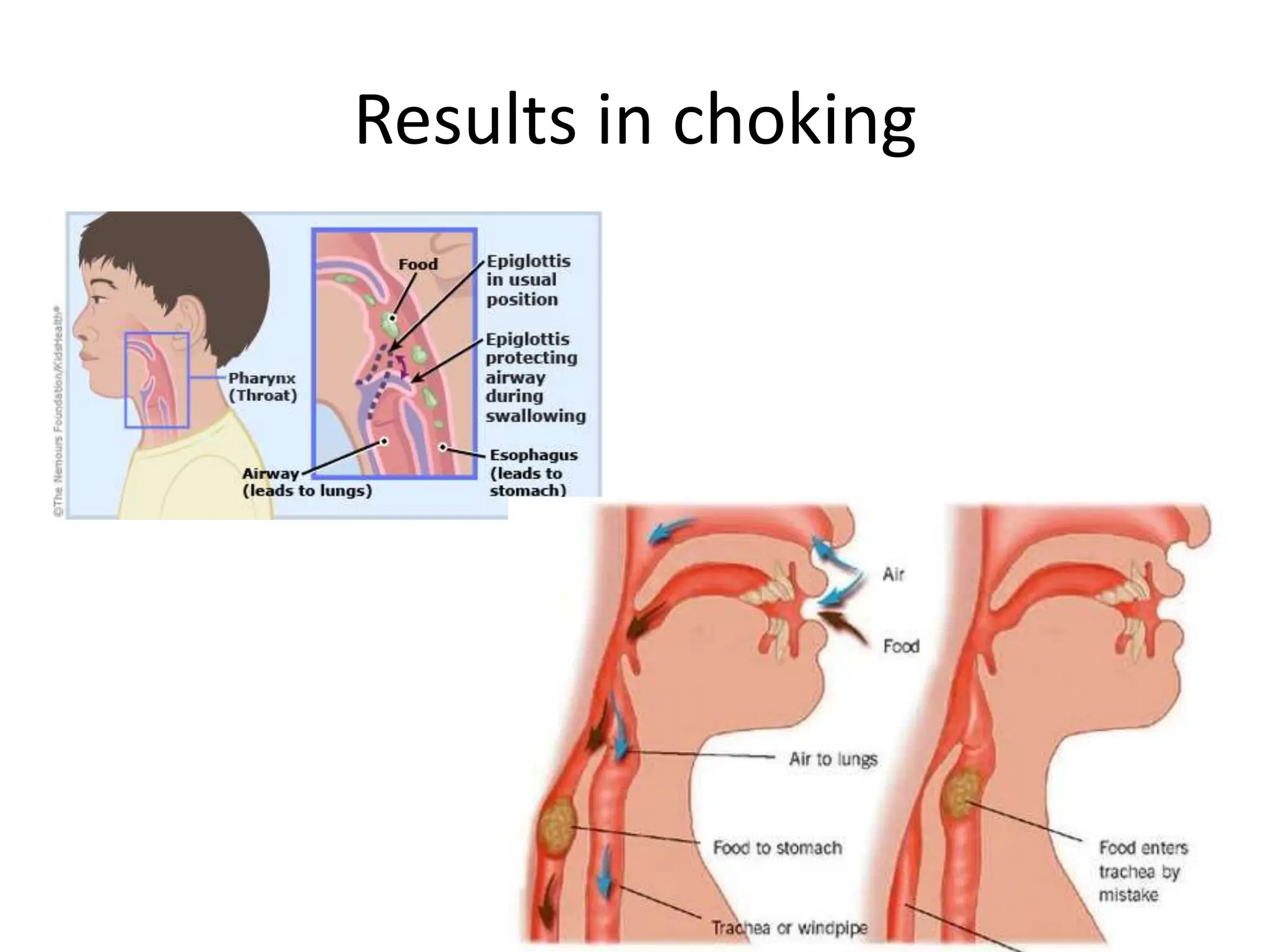 Results in choking
 