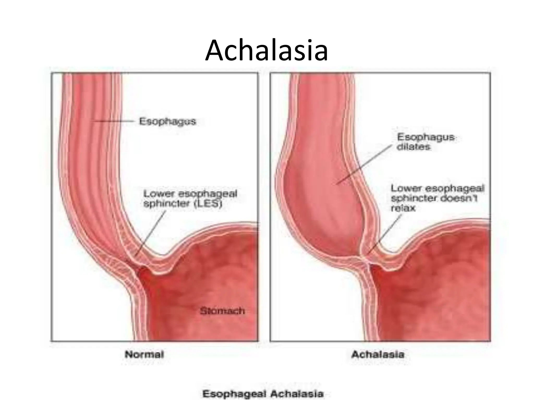 Achalasia
 