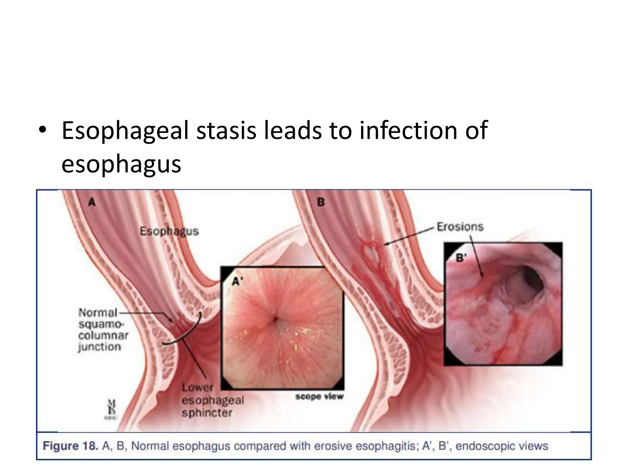 • Esophageal stasis leads to infection of
esophagus
 