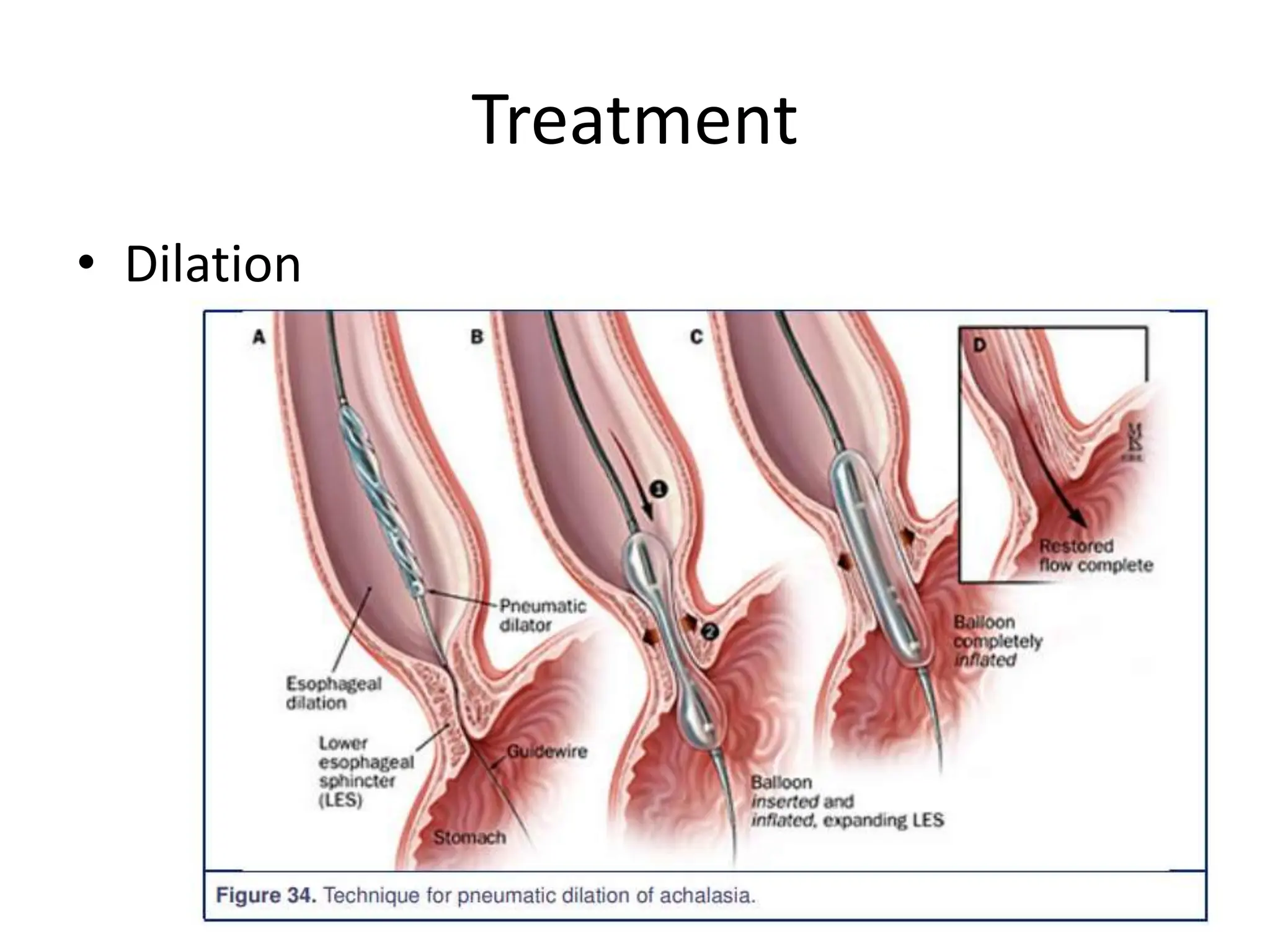 Treatment
• Dilation
 