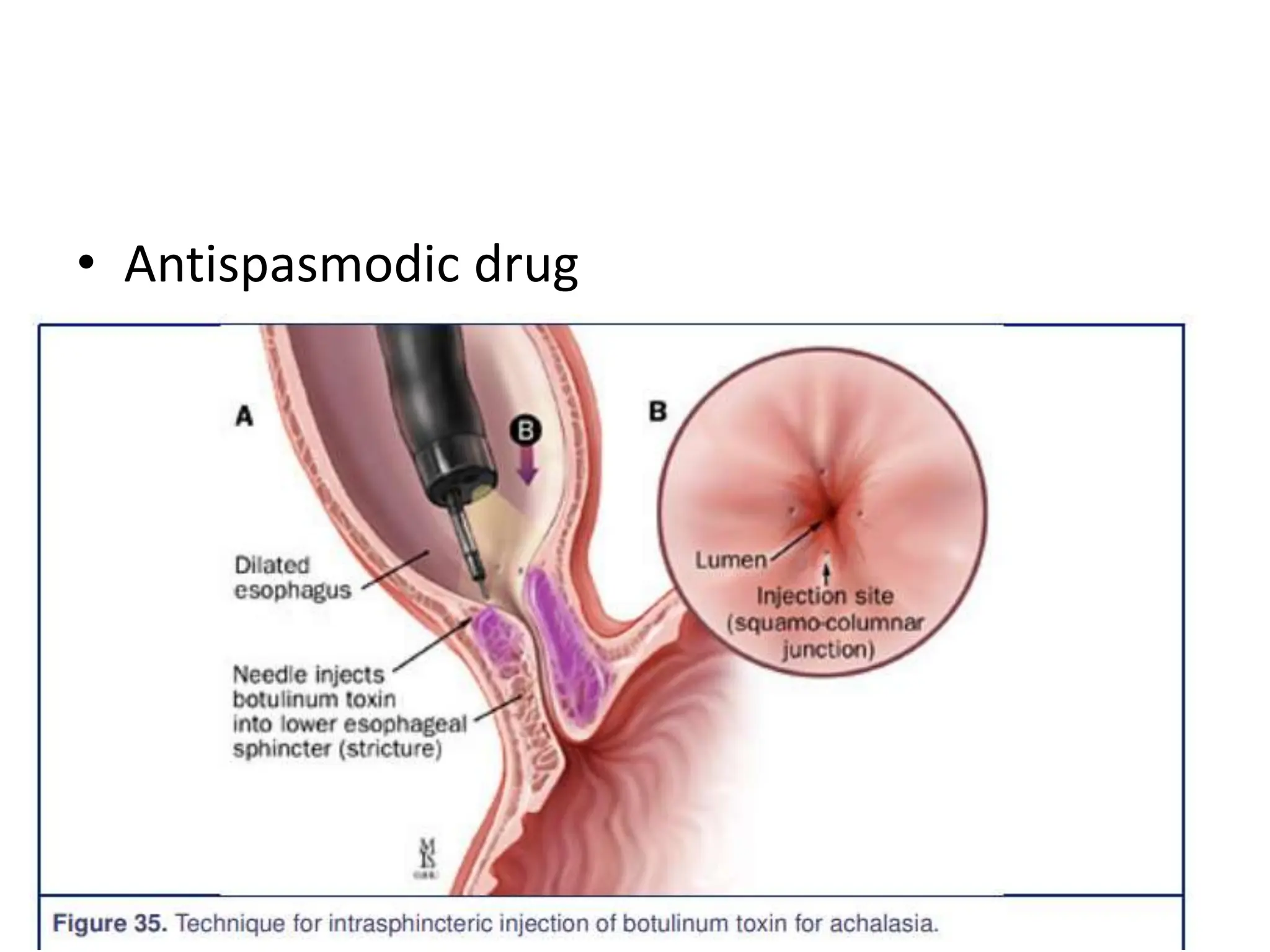 • Antispasmodic drug
 