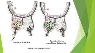 Resposta Inflamatória Aguda
Penetração da Bactéria
LPS
LPS
LPS
LPS
LPS
Reconhecimento
imunológico da bactéria
 