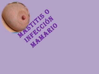 M
A
STITIS
O
INFECCIÓN
M
A
M
A
RIO
 