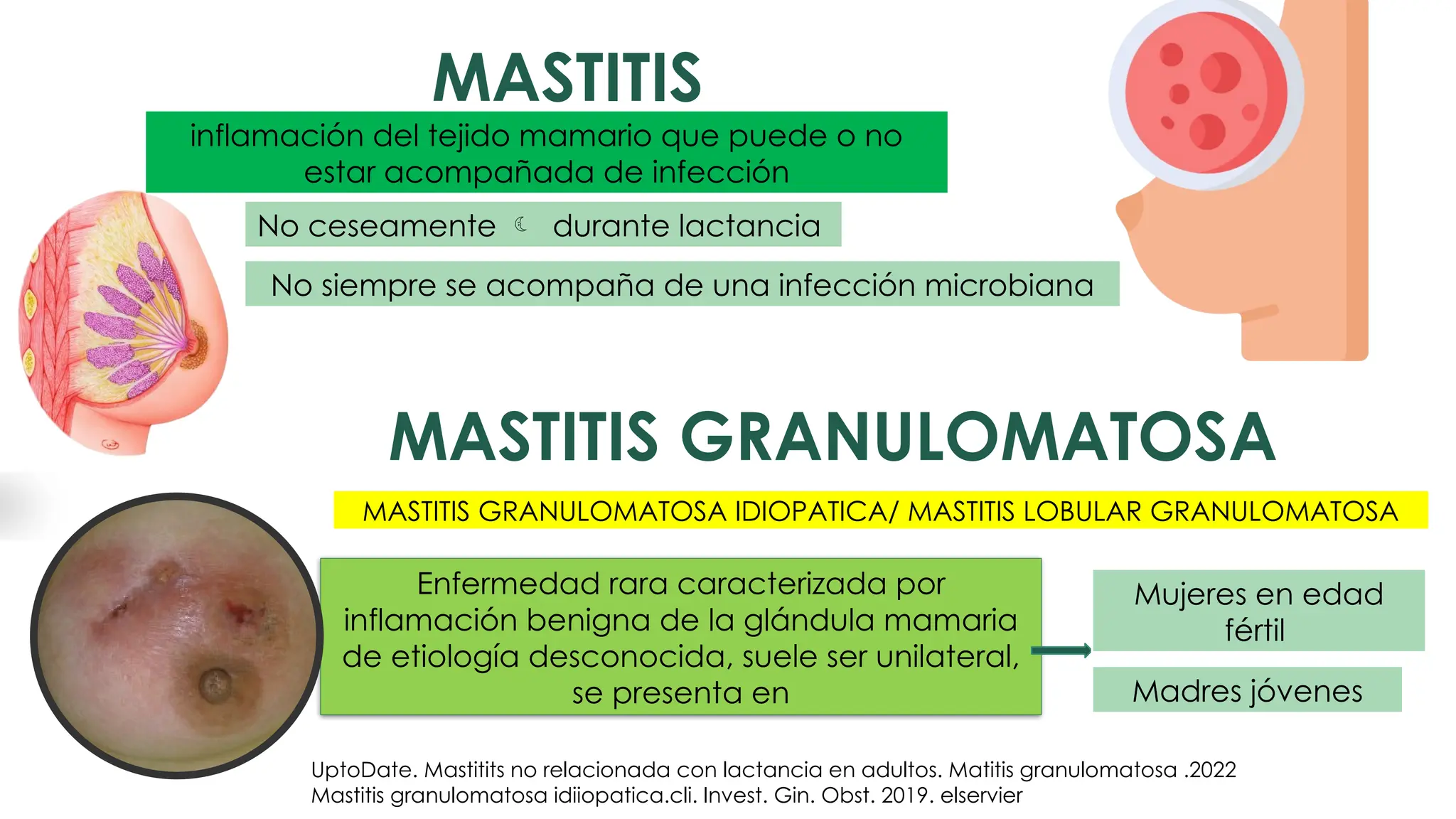 MASTITIS GRANULOMATOSA Diagnóstico ECOGRÁFICO | PPTX | Medical Health