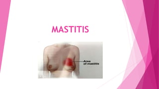 MASTITIS
 