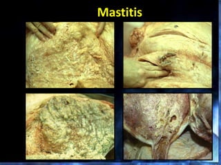 Mastitis
 