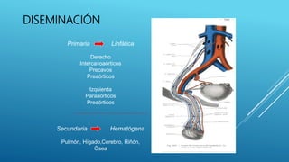 DISEMINACIÓN
Primaria Linfática
Derecho
Intercavoaórticos
Precavos
Preaórticos
Izquierda
Paraaórticos
Preaórticos
Secundaria Hematógena
Pulmón, Hígado,Cerebro, Riñón,
Ósea
 