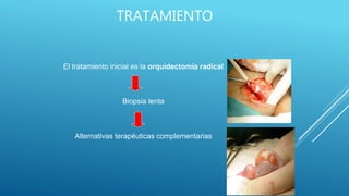 TRATAMIENTO
El tratamiento inicial es la orquidectomía radical
Biopsia lenta
Alternativas terapéuticas complementarias
 
