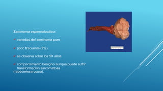 Seminoma espermatocítico:
 variedad del seminoma puro
 poco frecuente (2%)
 se observa sobre los 50 años
 comportamiento benigno aunque puede sufrir
transformación sarcomatosa
(rabdomiosarcoma).
 