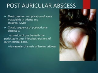 MASTOID ABSCESS, ear nose and throat presentation | PPT