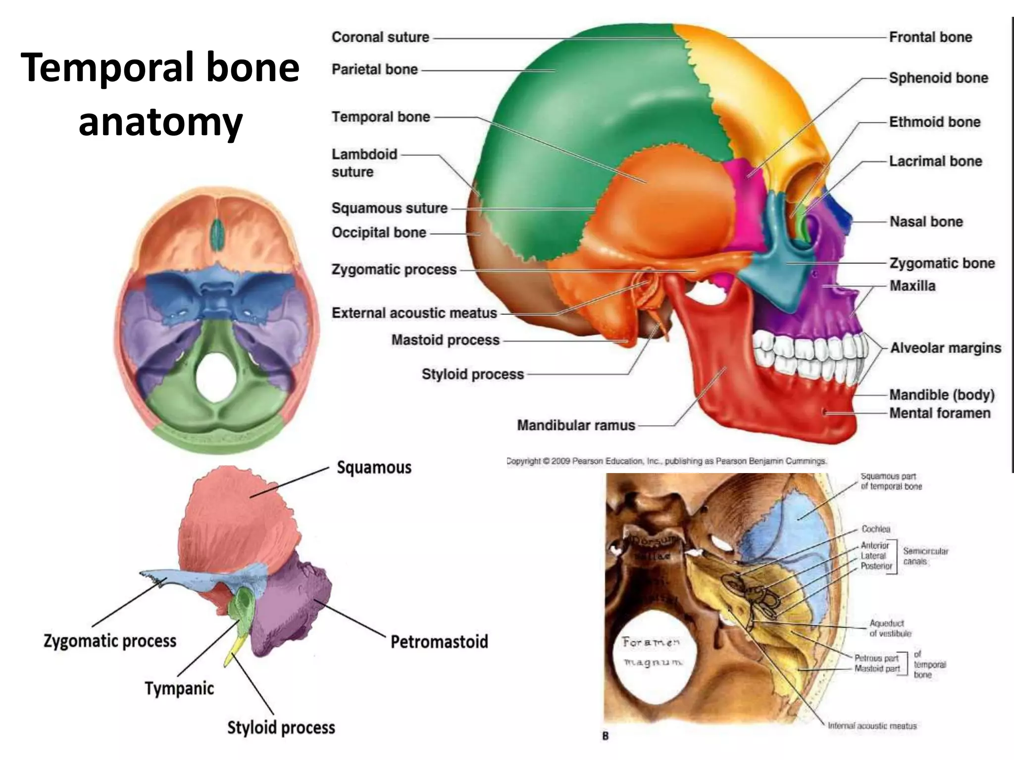 Mastoid Diseases Imaging PPTX mastoid-diseases-imaging-pptx