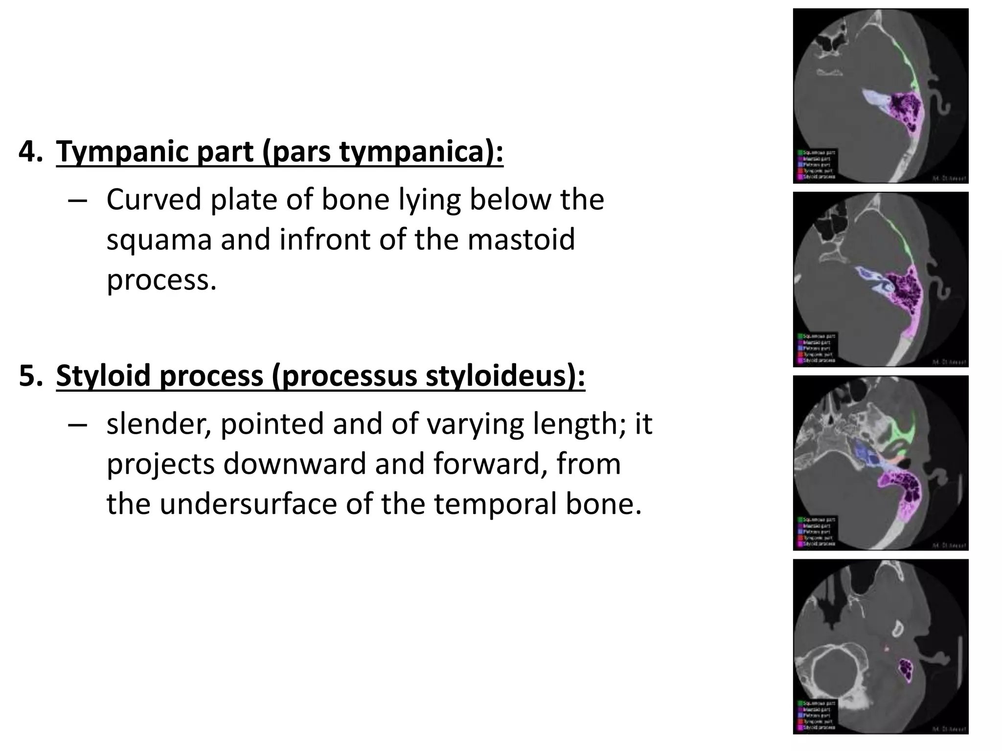 4. Tympanic part (pars tympanica):
– Curved plate of bone lying below the
squama and infront of the mastoid
process.
5. Styloid process (processus styloideus):
– slender, pointed and of varying length; it
projects downward and forward, from
the undersurface of the temporal bone.
 