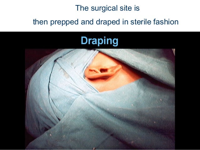 Mastoidectomy