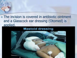  The incision is covered in antibiotic ointment
and a Glasscock ear dressing (Otomed) is
applied.
 