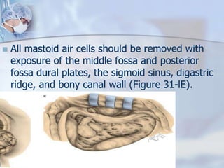  All mastoid air cells should be removed with
exposure of the middle fossa and posterior
fossa dural plates, the sigmoid sinus, digastric
ridge, and bony canal wall (Figure 31-lE).
 