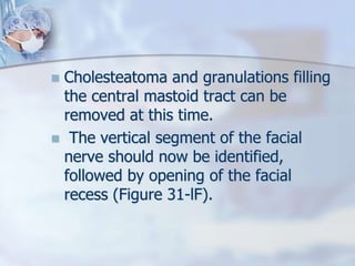  Cholesteatoma and granulations filling
the central mastoid tract can be
removed at this time.
 The vertical segment of the facial
nerve should now be identified,
followed by opening of the facial
recess (Figure 31-lF).
 