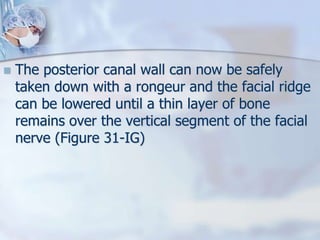  The posterior canal wall can now be safely
taken down with a rongeur and the facial ridge
can be lowered until a thin layer of bone
remains over the vertical segment of the facial
nerve (Figure 31-IG)
 