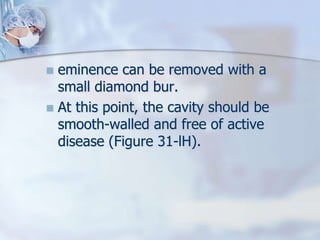  eminence can be removed with a
small diamond bur.
 At this point, the cavity should be
smooth-walled and free of active
disease (Figure 31-lH).
 