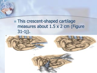  This crescent-shaped cartilage
measures about 1.5 x 2 cm (Figure
31-1j).
 