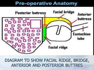 DIAGRAM TO SHOW FACIAL RIDGE, BRIDGE,
ANTERIOR AND POSTERIOR BUTTRES
 