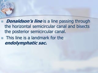  Donaldson’s line is a line passing through
the horizontal semicircular canal and bisects
the posterior semicircular canal.
 This line is a landmark for the
endolymphatic sac.
 