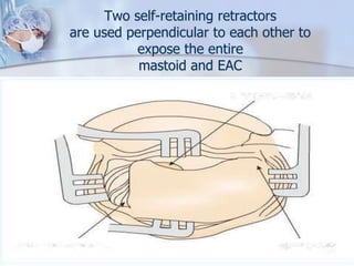 Two self-retaining retractors
are used perpendicular to each other to
expose the entire
mastoid and EAC
 