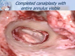 Completed canalplasty with
entire annulus visible
 