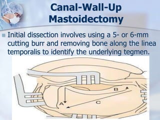 Canal-Wall-Up
Mastoidectomy
 Initial dissection involves using a 5- or 6-mm
cutting burr and removing bone along the linea
temporalis to identify the underlying tegmen.
 