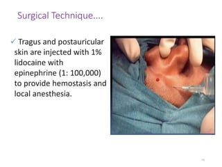 Postauricular Injection MASTOIDECTOMY PPT | PPT