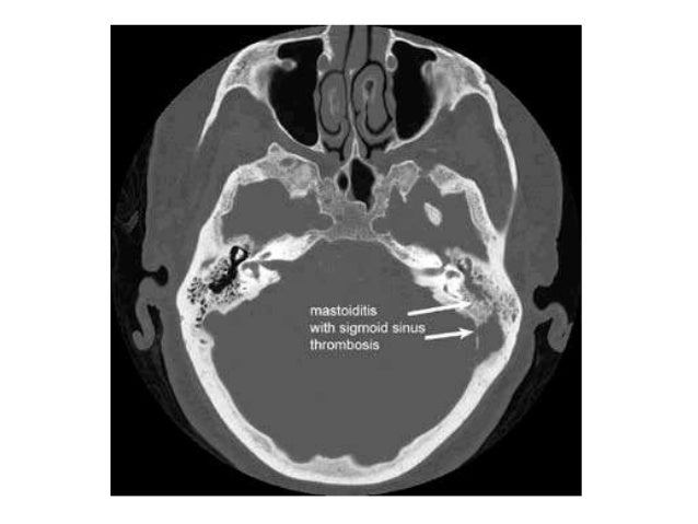 mastoiditis meningitis diagnosis