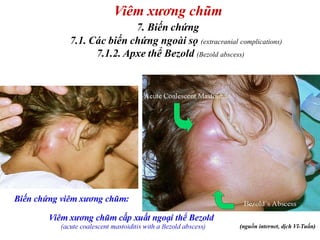 Mastoiditis part 1 | PDF