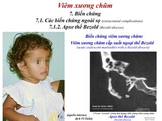 Mastoiditis part 1 | PDF