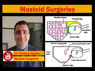 Dr. Krishna Koirala //
Mastoid Surgeries
 