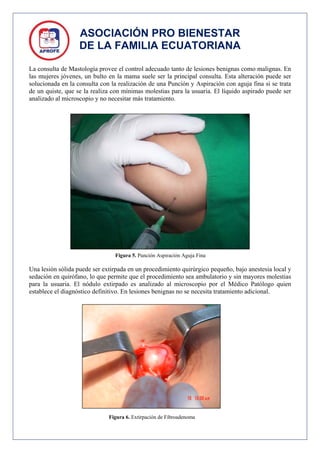 ASOCIACIÓN PRO BIENESTAR
                   DE LA FAMILIA ECUATORIANA

La consulta de Mastología provee el control adecuado tanto de lesiones benignas como malignas. En
las mujeres jóvenes, un bulto en la mama suele ser la principal consulta. Esta alteración puede ser
solucionada en la consulta con la realización de una Punción y Aspiración con aguja fina si se trata
de un quiste, que se la realiza con mínimas molestias para la usuaria. El líquido aspirado puede ser
analizado al microscopio y no necesitar más tratamiento.




                                Figura 5. Punción Aspiración Aguja Fina

Una lesión sólida puede ser extirpada en un procedimiento quirúrgico pequeño, bajo anestesia local y
sedación en quirófano, lo que permite que el procedimiento sea ambulatorio y sin mayores molestias
para la usuaria. El nódulo extirpado es analizado al microscopio por el Médico Patólogo quien
establece el diagnóstico definitivo. En lesiones benignas no se necesita tratamiento adicional.




                              Figura 6. Extirpación de Fibroadenoma
 