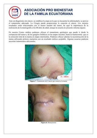 ASOCIACIÓN PRO BIENESTAR
                   DE LA FAMILIA ECUATORIANA

Ante un diagnóstico de cáncer, se establece la etapa en la que se encuentra la enfermedad y se provee
el tratamiento adecuado. La Cirugía puede proporcionar la curación al cáncer. Los mejores
resultados están relacionados con el menor tamaño del tumor, he aquí la importancia de la
realización de la mamografía a los 40 años de edad, aunque la usuaria no presente síntoma alguno.

En nuestra Centro médico podemos ofrecer el tratamiento quirúrgico que puede ir desde la
extirpación del tumor y de los ganglios linfáticos en las etapas iniciales, hasta la mastectomía que es
la remoción total de la mama en etapas intermedias. Podemos ofrecer además la reconstrucción de la
mama utilizando prótesis mamarias con un resultado estético aceptable. Algunas usuarias pudieran
necesitar tratamientos adicionales.




                           Figura 7. Tratamiento del Cáncer que conserva la mama




                                          Figura 8. Mastectomía
 