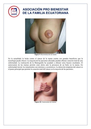 ASOCIACIÓN PRO BIENESTAR
                   DE LA FAMILIA ECUATORIANA




                                   Figura 9. Reconstrucción de mama

En la actualidad, la lucha contra el cáncer de la mama cuenta con grandes beneficios que la
tecnología puede ofrecer. La mayoría de las pacientes afectadas pueden obtener curación total de esta
enfermedad. La realización de la Mamografía ha ayudado a obtener estos buenos resultados. El
autoexamen de las mamas permite estar alerta ante la presencia de un bulto en la mama. En
enfermedad inicial, los tratamientos son mínimos y económicos. La detección temprana del cáncer es
el punto principal que permite la curación total del cáncer en la mayoría de las pacientes.




                                   Figura 10. Autoexamen de mamas
 