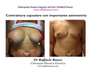 Mastopessi Napoli eseguito dal Dott. Raffaele Rauso 
www.raffaelerauso.com 
 