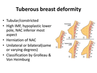 Tuberous breast deformity
• Tubular/constricted
• High IMF, hypoplastic lower
pole, NAC inferior most
aspect
• Herniation of NAC
• Unilateral or bilateral(same
or varying degrees)
• Classification by Grolleau &
Von Heimburg
 