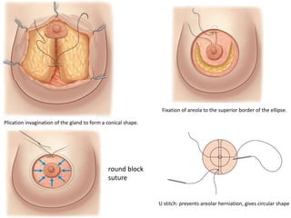 Plication invagination of the gland to form a conical shape.
Fixation of areola to the superior border of the ellipse.
round block
suture
U stitch: prevents areolar herniation, gives circular shape
 