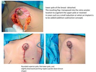 Rounded superior pole, flat lower pole, and
slightly downward pointing nipple.(upside down breast
shape)
lower pole of the breast detached.
The resulting flap transposed into the retro-areolar
location to augment the upper pole or resected
in cases such as a small reduction or when an implant is
to be added (addition-subtraction concept)
 