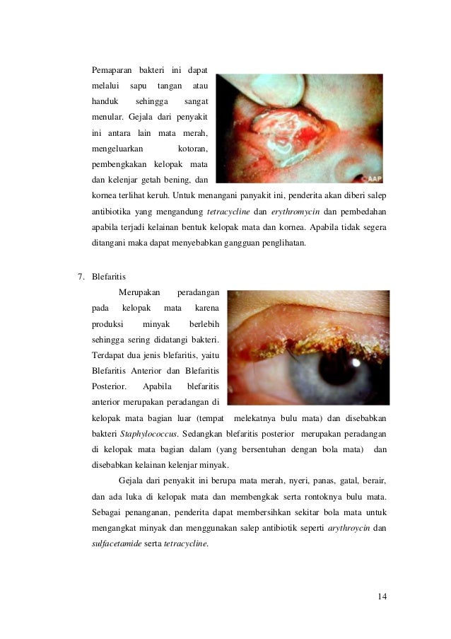 Ubat Sapu Mata Bengkak - Berubat