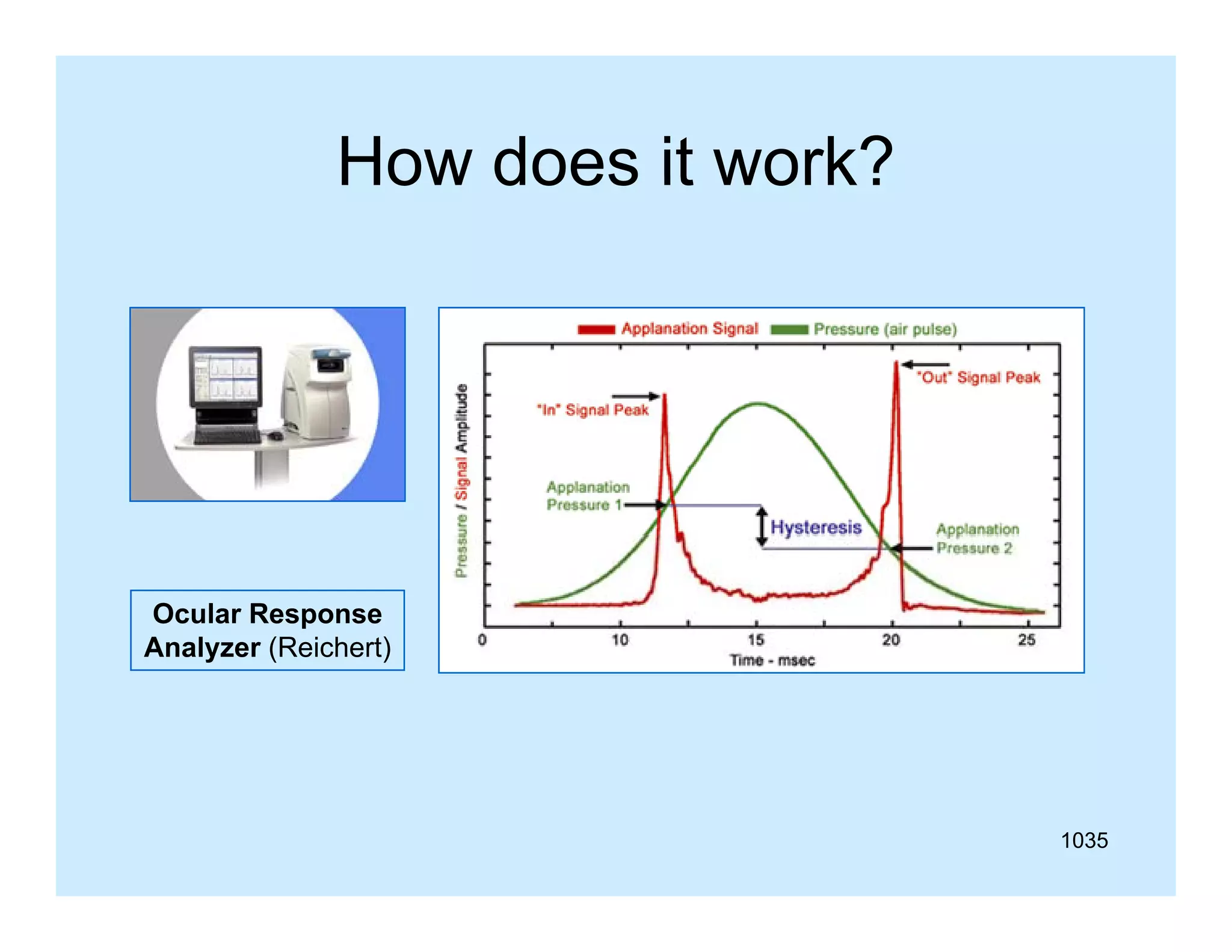 How does it work?

Ocular Response
Analyzer (Reichert)

1035

 