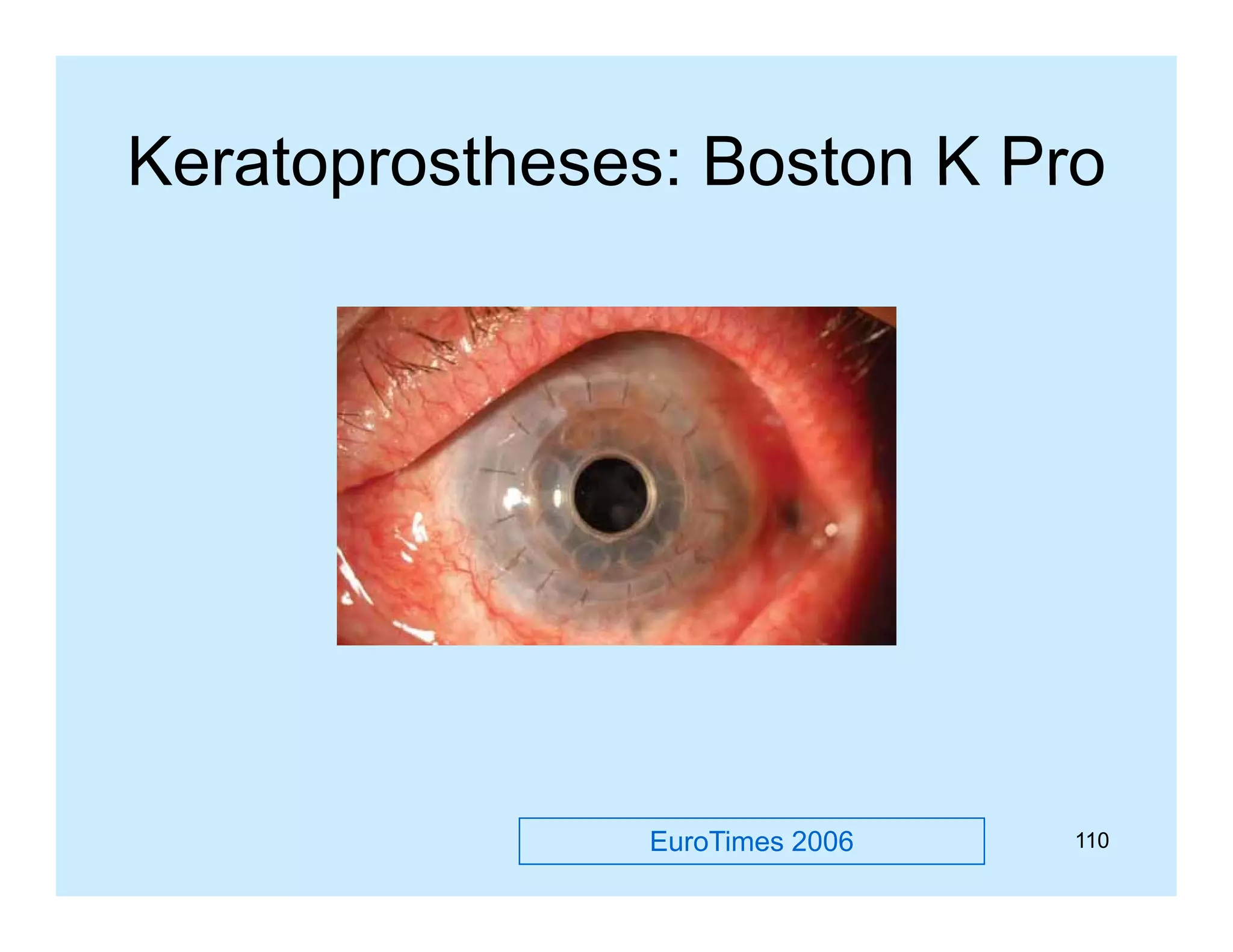 Keratoprostheses: Boston K Pro

EuroTimes 2006

110

 