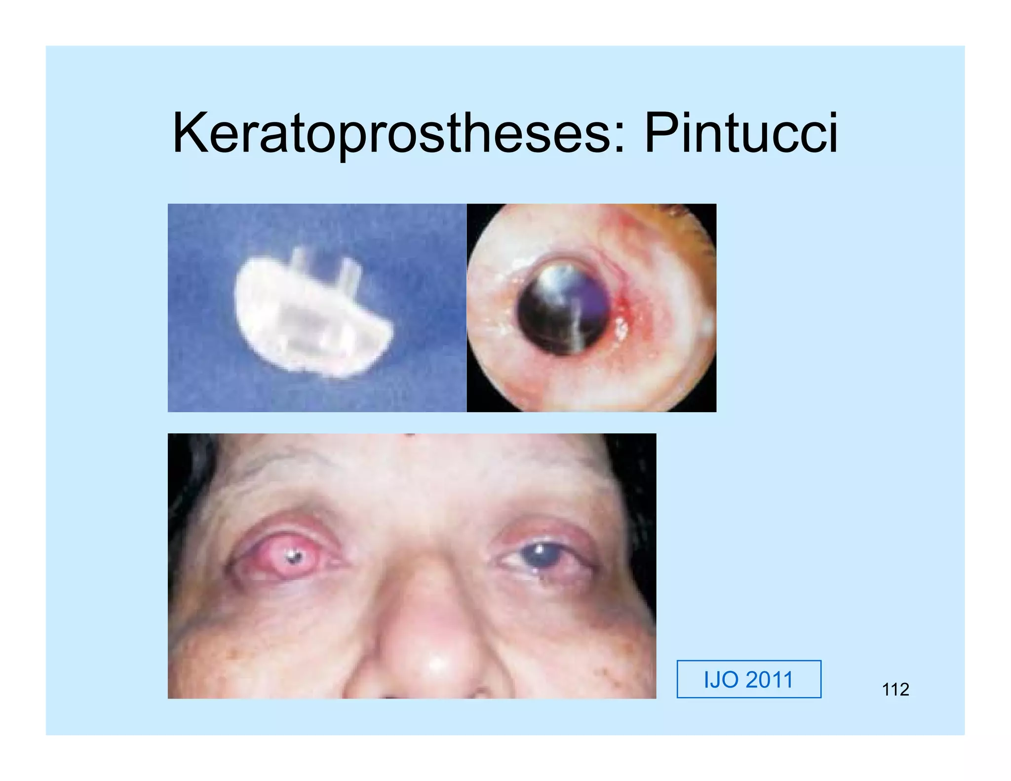 Keratoprostheses: Pintucci

IJO 2011

112

 
