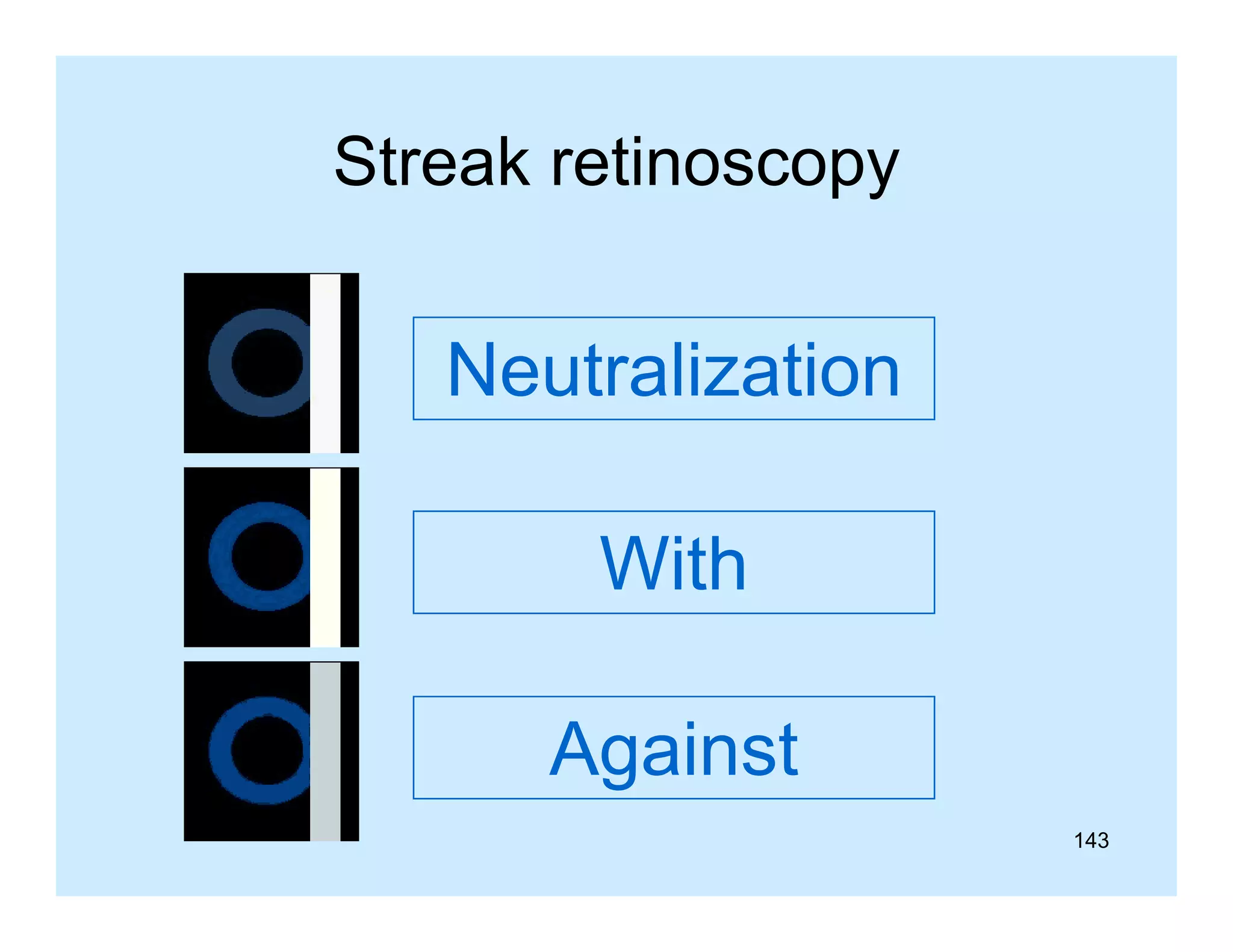 Streak retinoscopy

Neutralization
With
Against
ga s
143

 