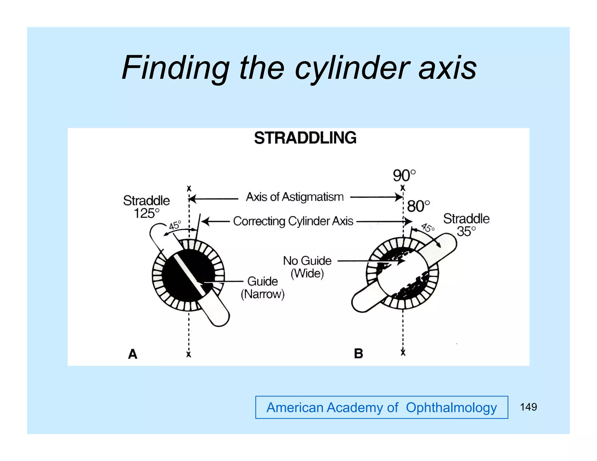 Finding the cylinder axis
g
y

American Academy of Ophthalmology

149

 